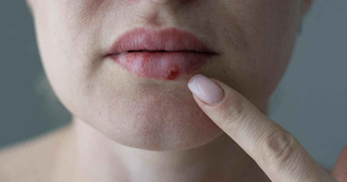 Después de casi treinta años, un antiviral oral nuevo para el herpes que ya no responde a nada