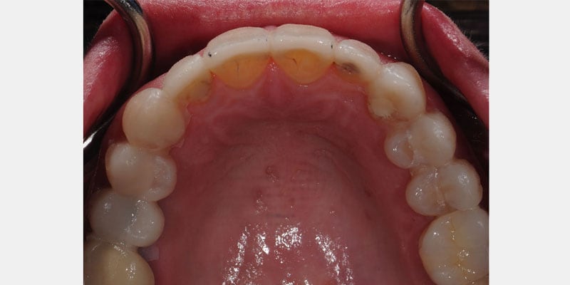 Carillas dentales: la filtración aparece en los bordes y puede comprometer el diente